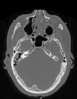 CT image of head