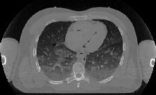 CT image of thorax