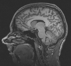 MR image of brain
